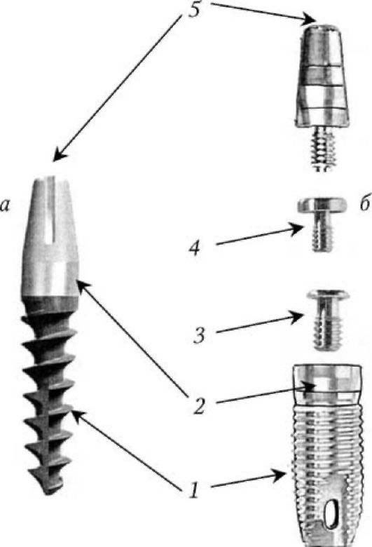 Схема импланта зуба